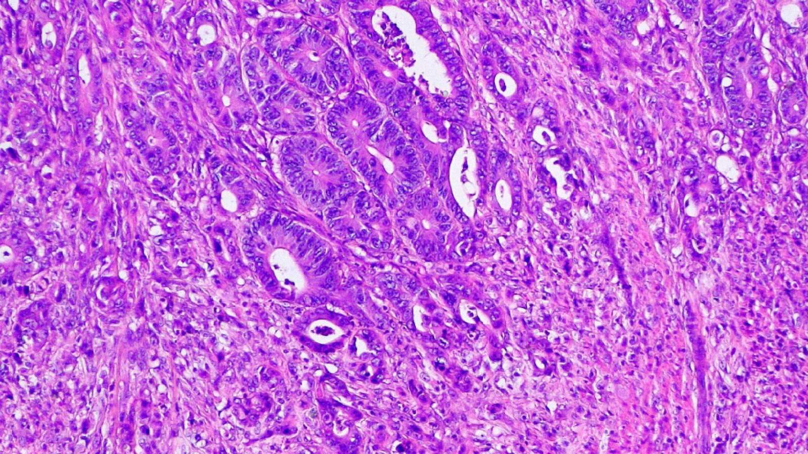 Cancer Du Colon Coloration He Galleries Nikon Instruments Inc